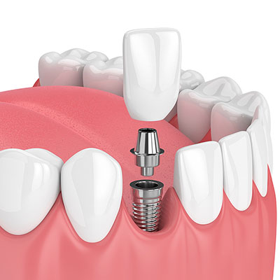 dental implant